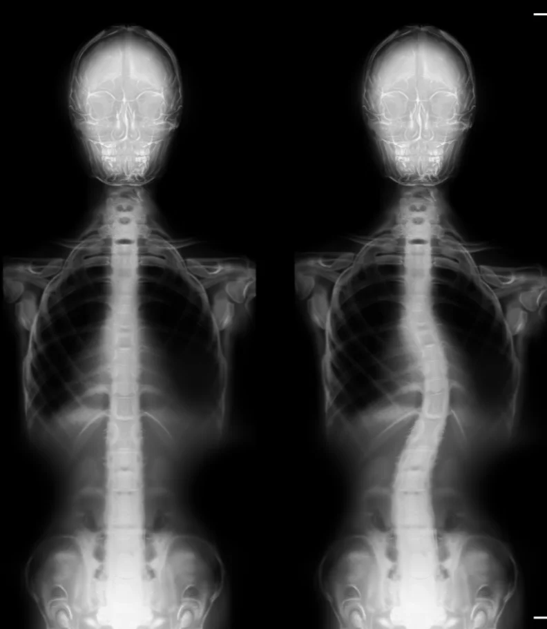 Scoliosis Fort Collins