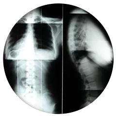 Chiropractic Fort Collins CO X Rays