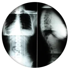 Chiropractic Fort Collins CO X Rays